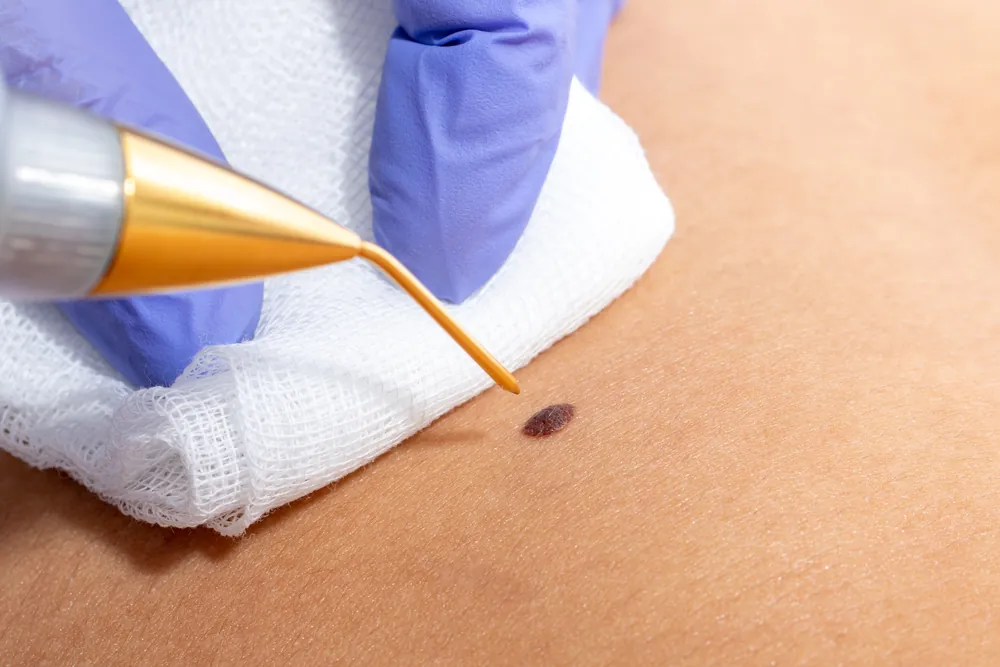 Skin lesion removal
